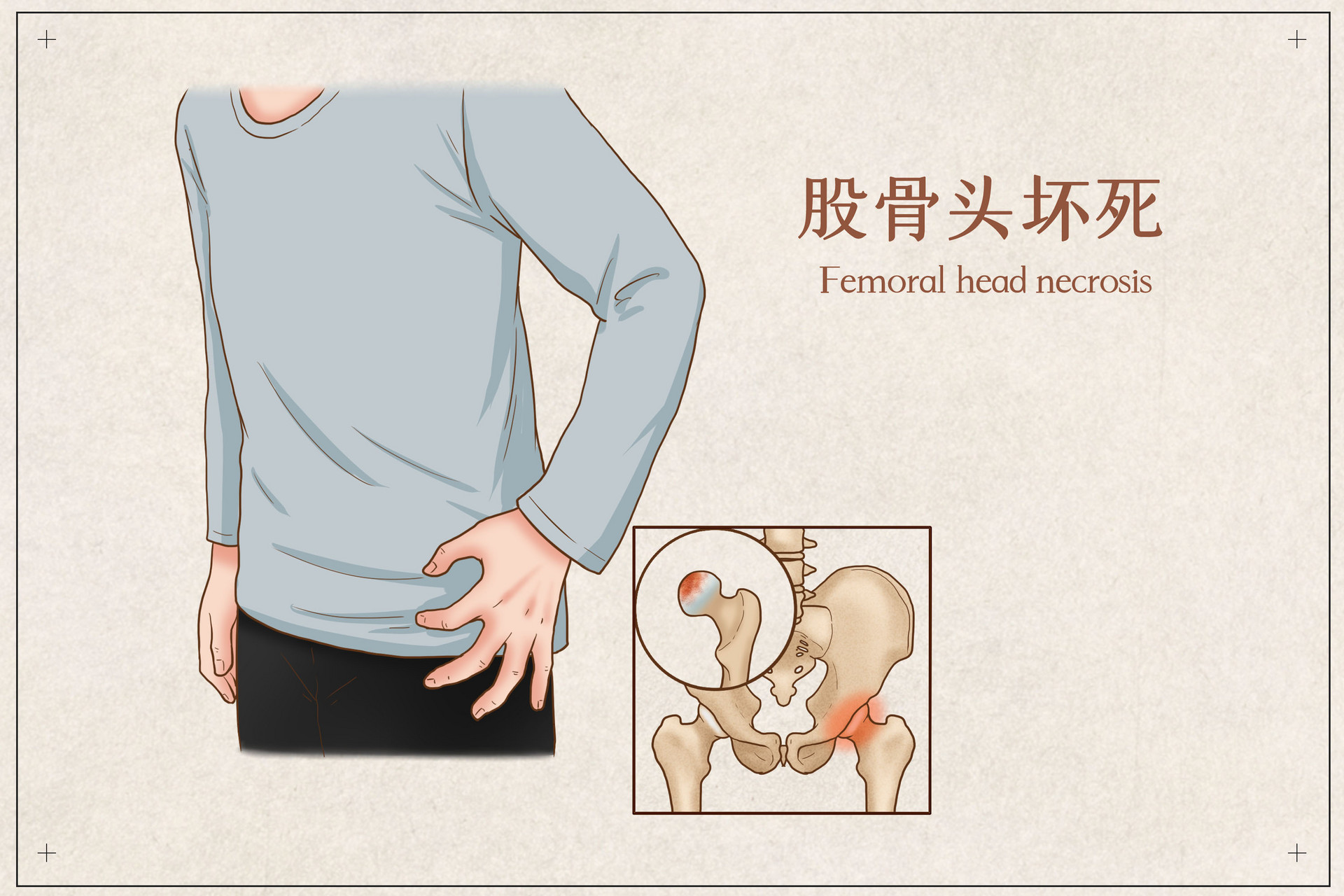 攝圖網_401866175_股骨頭壞死醫療插畫(企業商用)(1).jpg